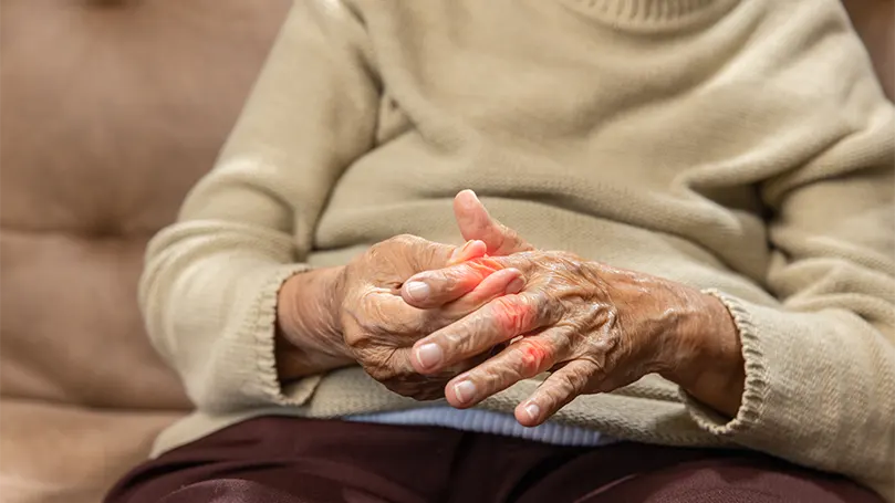 Immagine di una donna anziana affetta da artrite reumatoide.