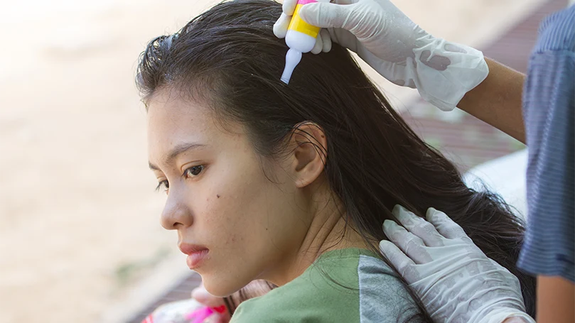 Immagine di una donna che utilizza un trattamento antipidocchi per i suoi capelli.