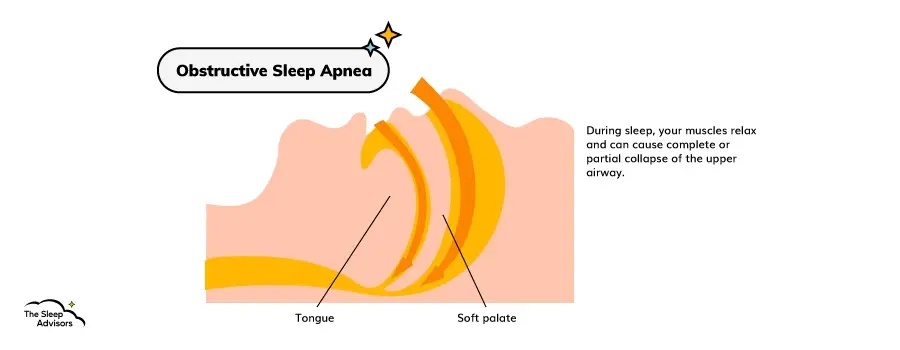 Infografica che illustra come si verifica l'apnea ostruttiva del sonno